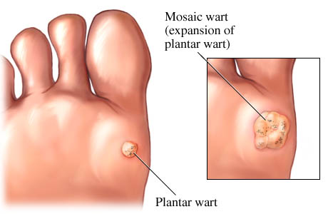 foot wart removal singapore)