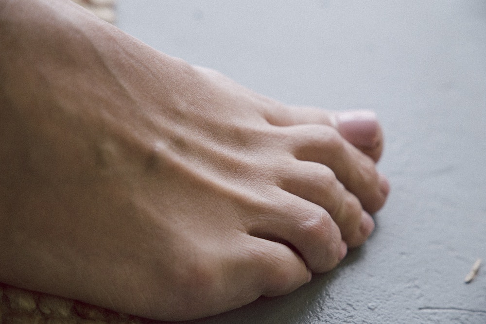 What is Hammer Toe? Symptoms, Causes, Diagnosis & Physiotherapy Treatment  of Hammer Toe.